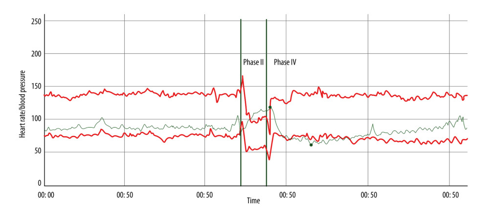 Beat-to-beat heart rate and blood pressure during the Valsalva maneuver demonstrating normal late phase II blood pressure recovery, indicating preserved sympathetic vasoconstrictor function. Phase IV blood pressure overshoot is mildly delayed, suggesting subtle slowing of adrenergic baroreflex recovery without evidence of significant adrenergic failure. The Valsalva ratio is 2.64 (5th percentile 1.46), consistent with preserved cardiovagal function. Red tracings denote systolic and diastolic blood pressure, and the green tracing denotes heart rate. Vertical green lines indicate onset and release of strain during the Valsalva maneuver.