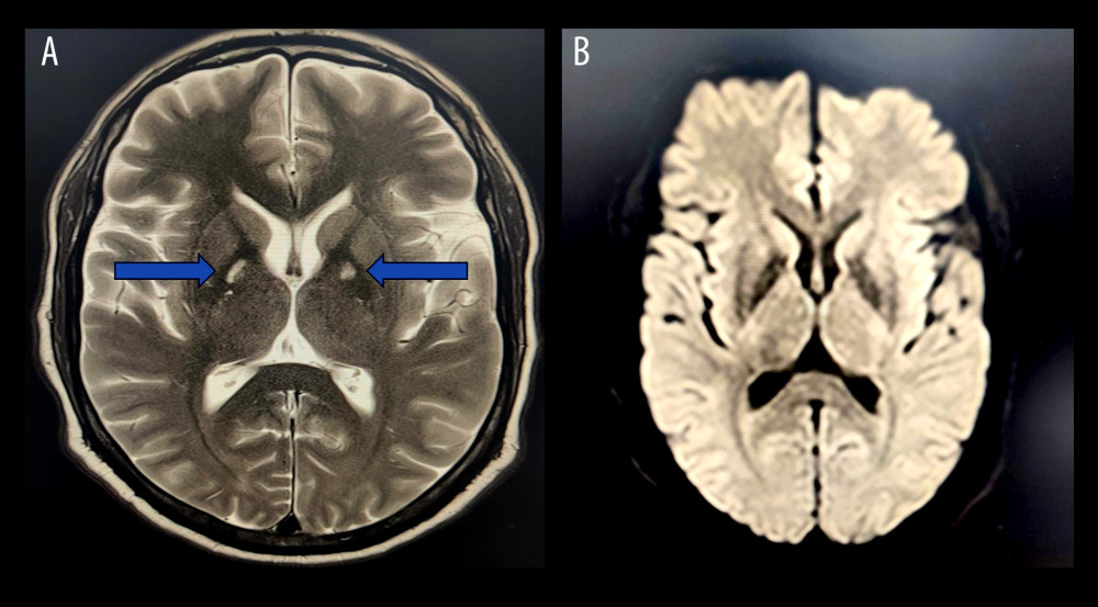 Axial magnetic resonance imaging of the brain demonstrating T2 hyperintensity in the bilateral globus pallidus (indicated by blue arrows) (A), with no corresponding diffusion restriction on the diffusion-weighted image (B).