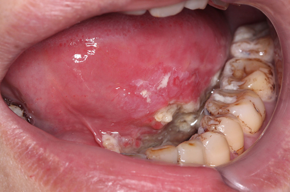 A mass located on the left floor of the mouth.