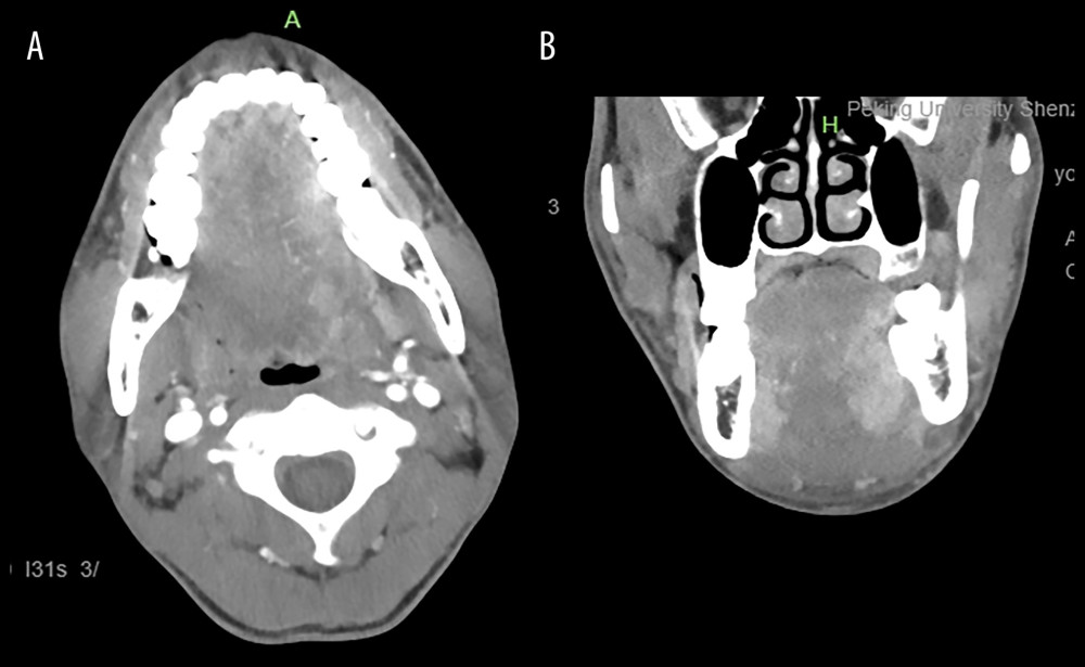 Computed tomography images of the mass. (A) Axial plane of the mass. (B) Coronal plane of the mass.