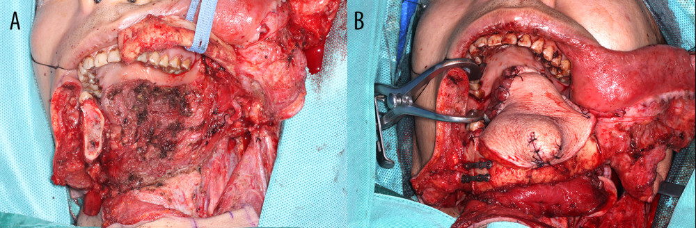 Intraoperative photos. (A) Postresection. (B) Free flap repair.