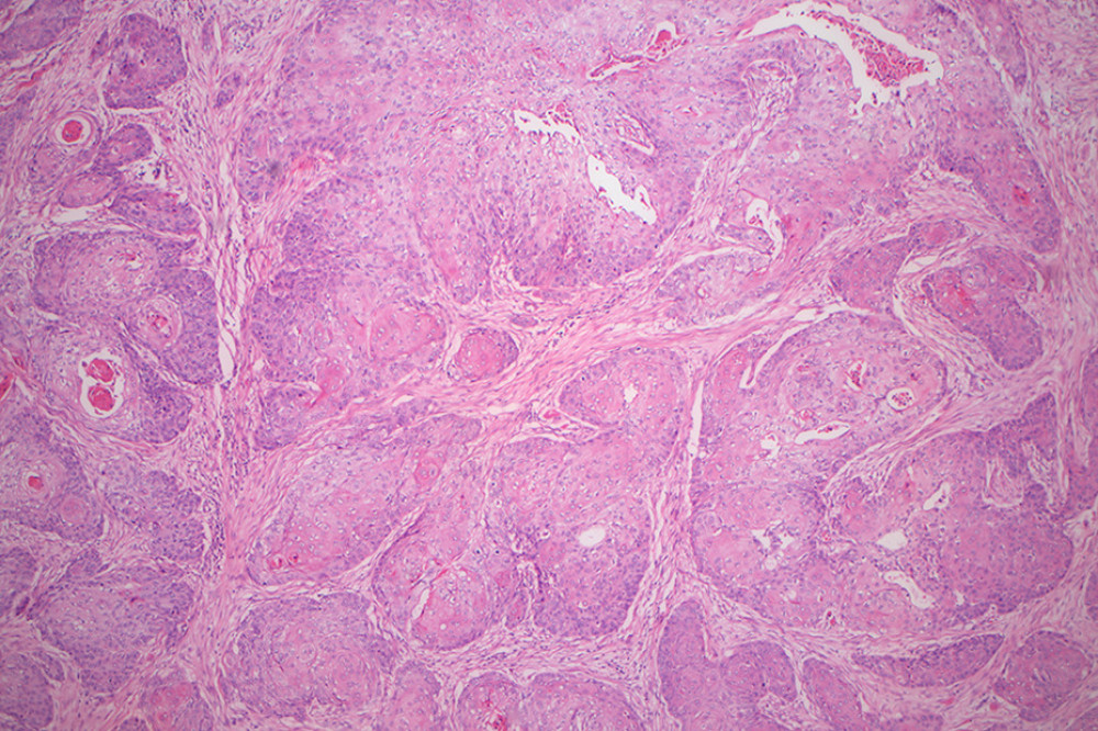 Pathology section of the tumor (H&E staining, magnification 50 ×).