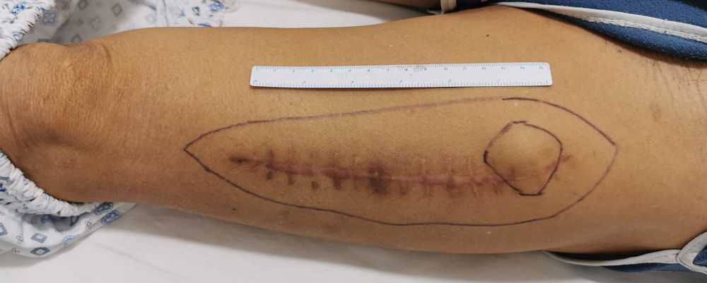 The mass in the left thigh.
