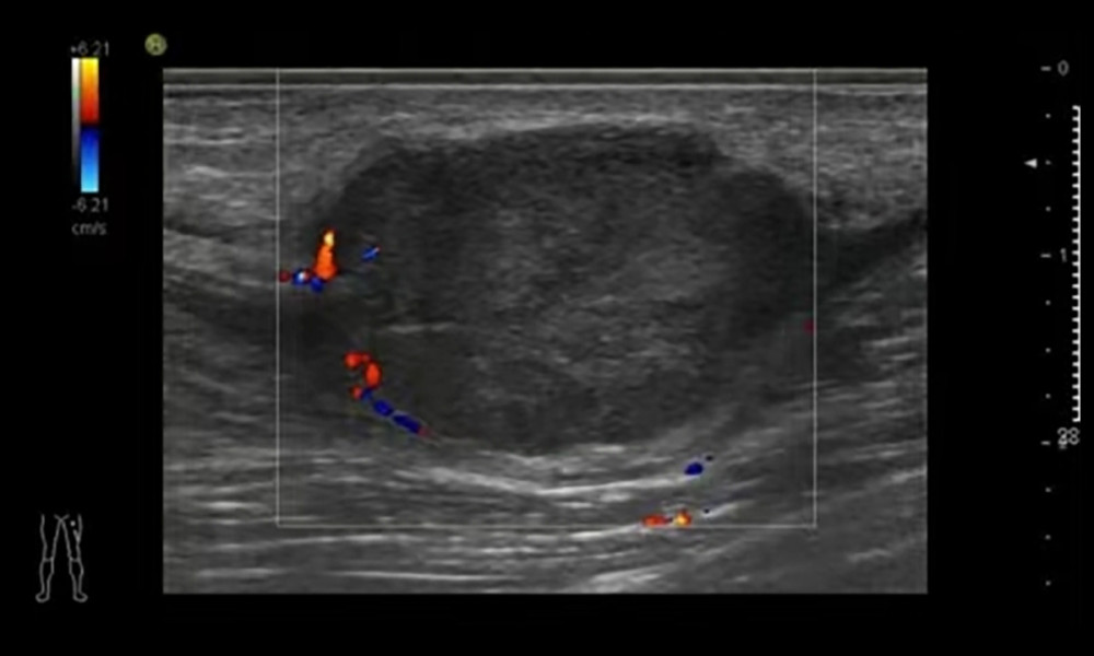 Ultrasound image of the mass in the left thigh.
