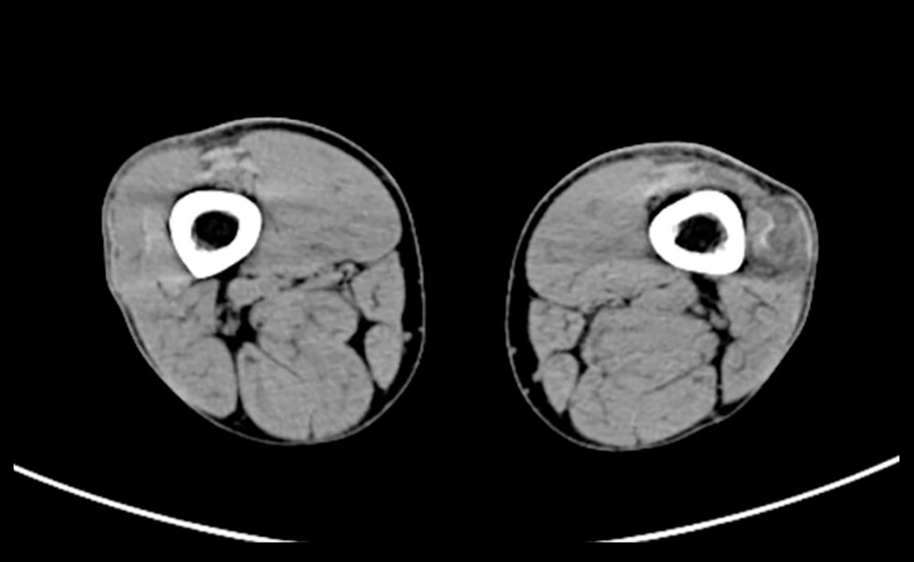 Computed tomography scan of the left thigh.