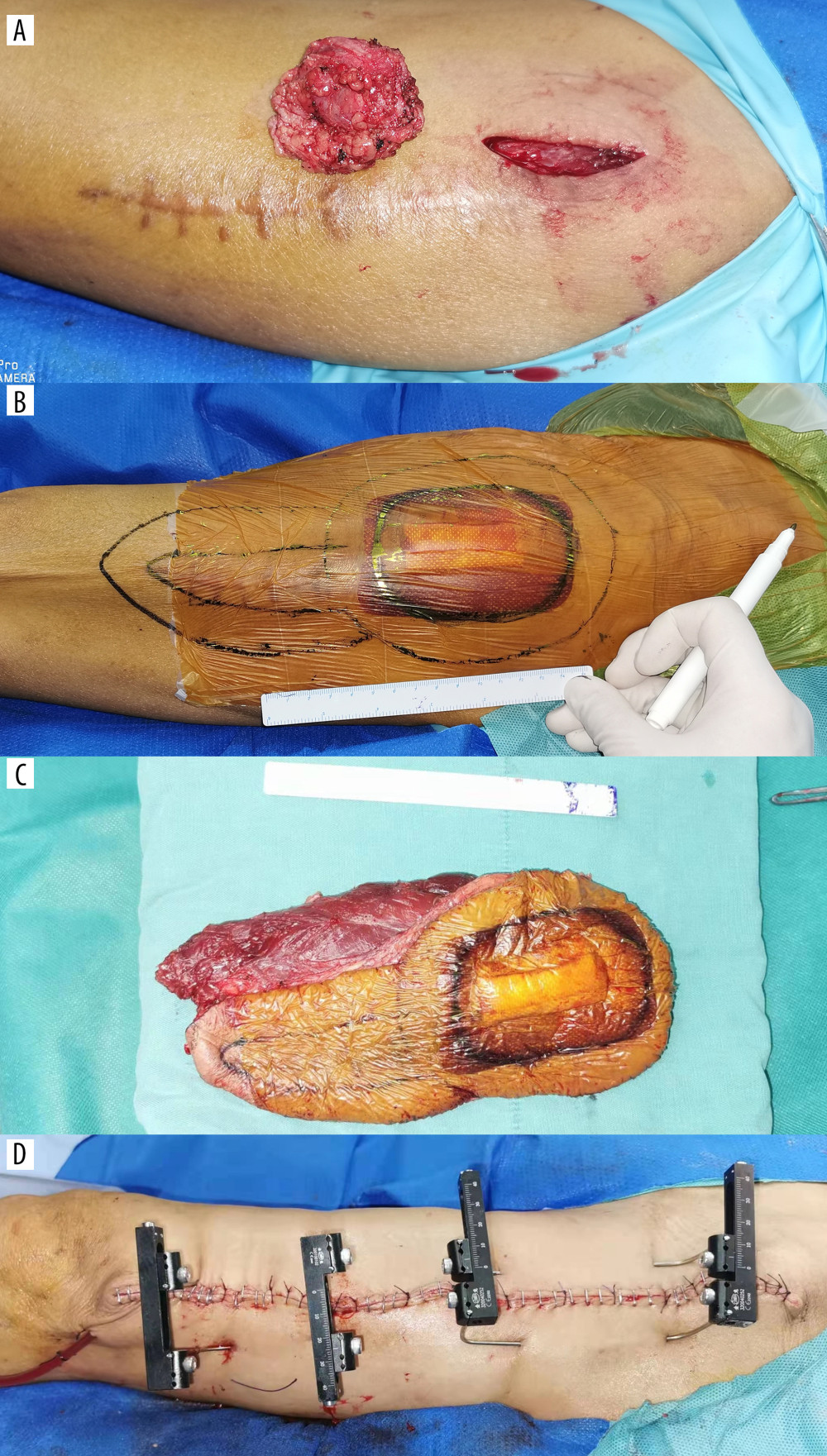 Intraoperative excision of the mass in the left thigh. (A) Local resection of the thigh mass. (B) After pathological confirmation of malignant tumor, the tumor was enlarged and resected. (C) Excision specimen. (D) Closure of the wound.