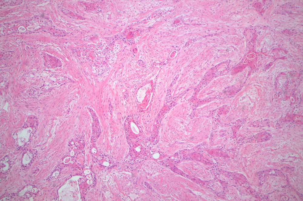 Pathology of the left thigh (H&E staining, magnification 50 ×).