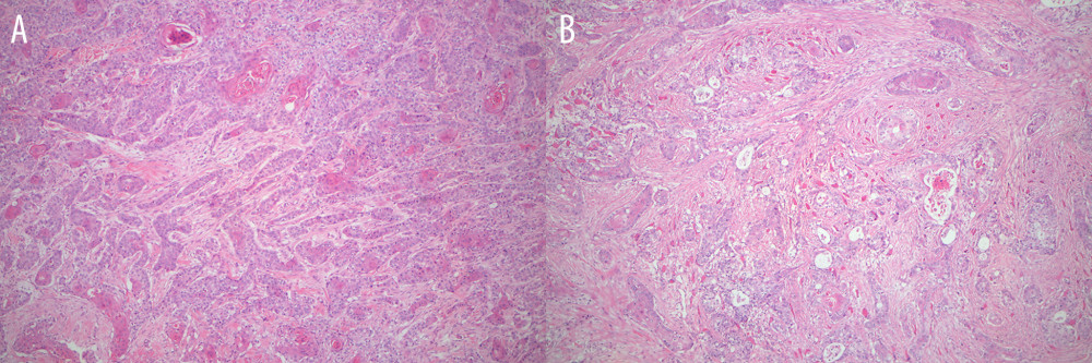 Pathological sections of the masses on the back and chest. (A) The back mass. (B) The chest mass (H&E staining, magnification 25 ×).