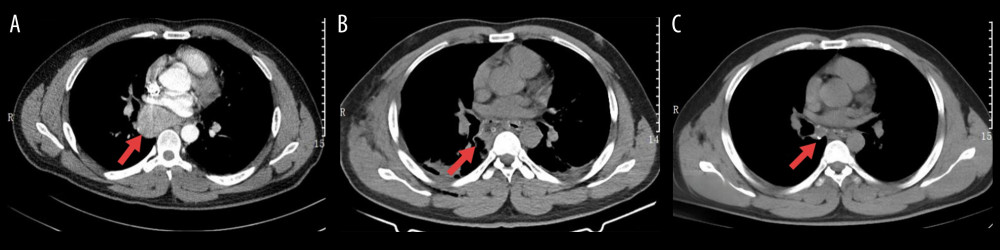 (A) Preoperative chest enhanced computed tomography revealed that the lesion was located below the tracheal carina and adjacent to the right main bronchus. (B) Postoperative chest computed tomography revealed complete resection of the mass. (C) Postoperative chest computed tomography scan 1 month later showed good recovery.