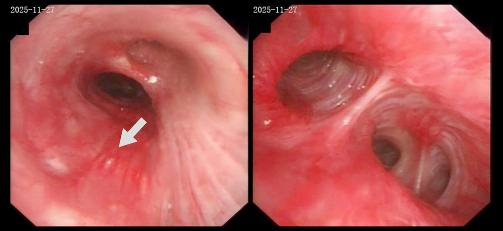 Bronchoscopy revealed mucosal congestion and swelling near the right main bronchial carina. Puncture biopsy of the mediastinal mass under bronchoscopy was performed at the site indicated by the arrow.