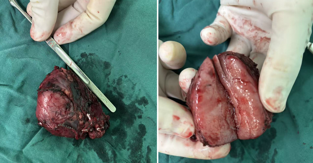 The resected mass had well-defined margins and homogeneous internal consistency.