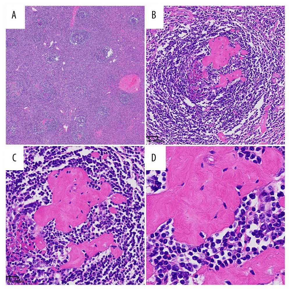 The pathological features of the patient’s lesion align with the histological characteristics of Castleman disease (hematoxylin-eosin stain). In the interlayered zone, lymphocytes are arranged in concentric circles resembling the layers of an onion, accompanied by penetration of transparent blood vessels through the atrophic germinal center. (A) Low-power view (hematoxylin-eosin, × 25), (B) High-power view (hematoxylin-eosin, × 200), (C) High-power view (hematoxylin-eosin, × 400), (D) High-power view (hematoxylin-eosin, × 800).
