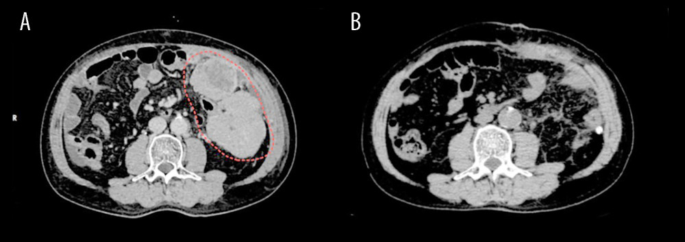 Abdominal computed tomography (CT) images of the patient with peritoneal metastasis from hepatocellular carcinoma. (A) Pretreatment CT scan showing a solitary soft-tissue mass in the left abdominal cavity (outlined by the red dashed line) with heterogeneous enhancement. (B) Posttreatment CT scan demonstrating disappearance of the previous peritoneal lesion, indicating a favorable treatment response.