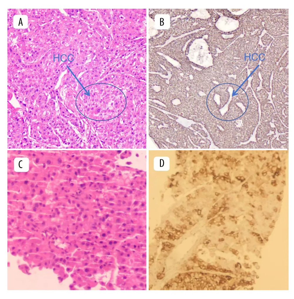 Pathological findings revealed moderately differentiated hepatocellular carcinoma (HCC). (A) Hematoxylin and eosin staining; observation mode: 2-dimensional planar observation; internal scale: 1 unit = 100–200 μm (low power), showing a typical trabecular arrangement of tumor cells with pronounced cellular atypia, an increased nuclear-to-cytoplasmic ratio, and no obvious cholestasis. (B) Immunohistochemical (IHC) staining; observation mode: 2-dimensional planar observation; internal scale: 1 unit = 100–200 μm (low power), showing negative expression of alpha-fetoprotein (AFP) in tumor cells, confirming the diagnosis of AFP-negative HCC. (C) Hematoxylin and eosin staining; observation mode: 2-dimensional planar observation; internal scale: 1 unit = 25–50 μm (high power), showing largely preserved hepatic lobular architecture, a regular arrangement of hepatocytes, and no clinically significant inflammation or fibrosis. (D) IHC staining; observation mode: 2-dimensional planar observation; internal scale: 1 unit = 25–50 μm (high power), showing diffuse cytoplasmic expression of Ki-67 in HCC cells and supporting the pathological diagnosis of HCC.