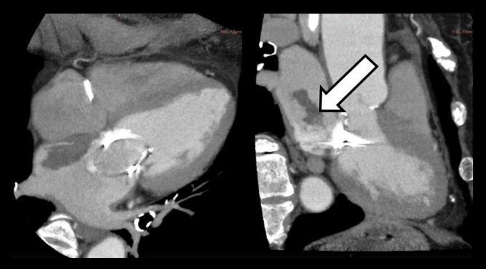 Left and right, prospective axial and sagittal views. Arrows indicate a mass inside the left atrium along the atrial septum.