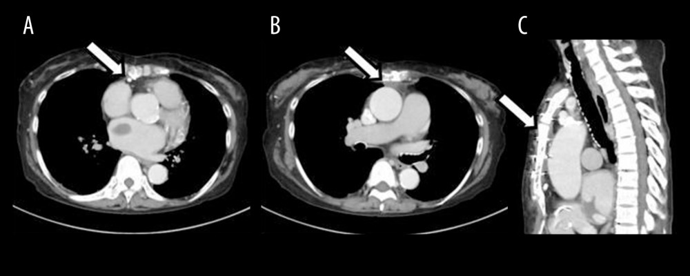 Contrast-enhanced computed tomography images. (A) Arrow indicates the right coronary artery near the back of the sternum. (B, C) High degree of collusion around the aortic root.