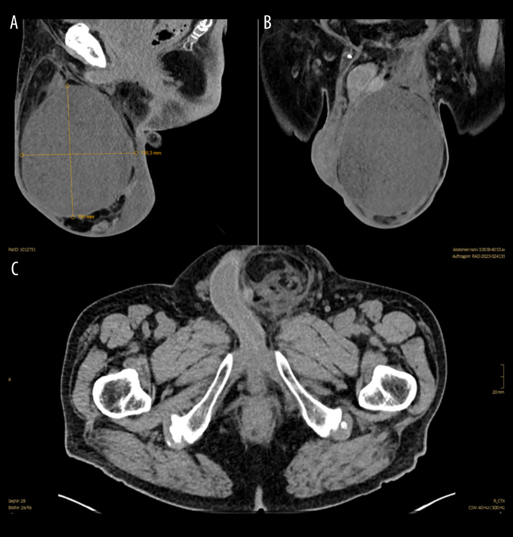 CT scan of the pelvis [A] sagittal; [B] coronal; [C] transversal plane: a well-defined mass measuring approximately 20 × 13 × 12 cm originating from the spermatic cord, surrounded by a hydrocele.