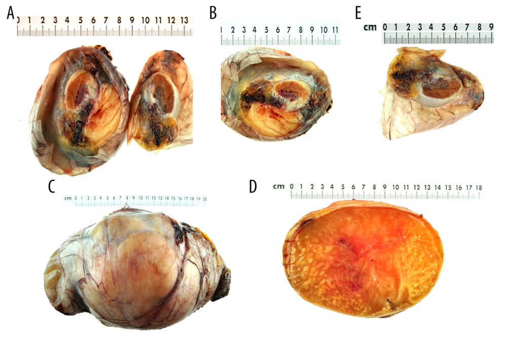(A–E) Completely resected liposarcoma of the left spermatic cord measuring 20 × 13 × 12 cm, weighing approximately 3 kg.