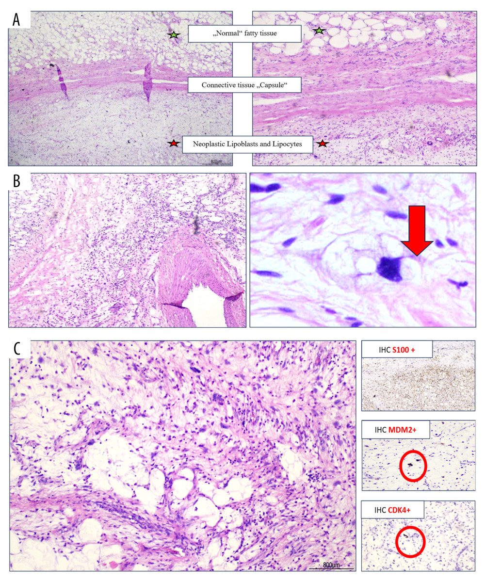 Histological specimen (H&E): In the upper section of the image, the normal adipose tissue of the well-differentiated liposarcoma can be seen, exhibiting a harmonious structure (R0 Grade 1 UICC). In the lower section, the neoplastic tissue is evident, characterized by numerous mitoses and nuclear polymorphisms, displaying pleomorphic cellular morphology. [A] Liposarcoma G1 Structure; [B] Neoplastic Lipoblasts and Lipocytes; [C] Analyzing immunohistochemistry (IHC): S100+, MDM2+, CDK4+.