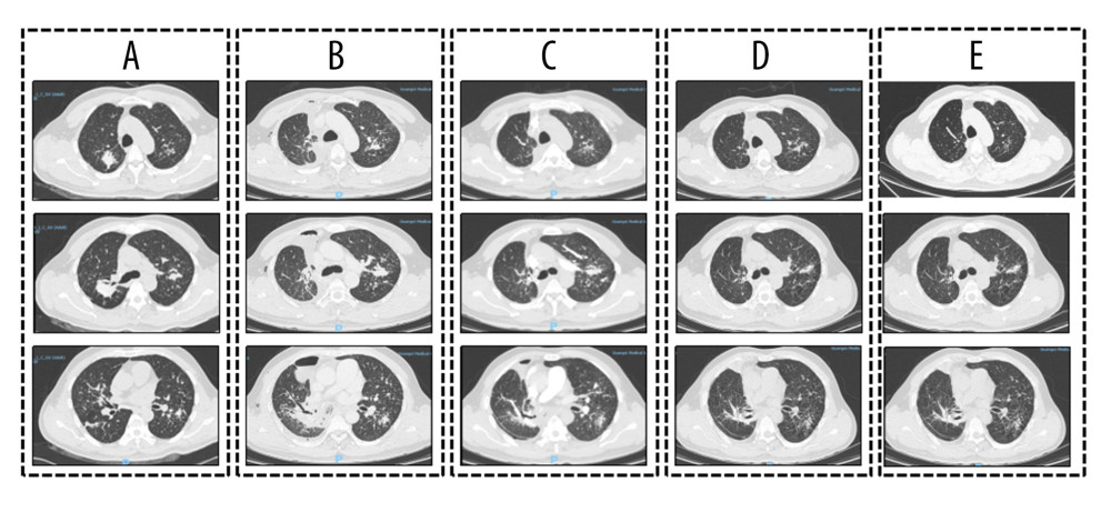 Chest computed tomography (CT) findings at various clinical stages(A) Before surgery: CT images show irregular contrast-enhanced soft-tissue masses in the bilateral upper lungs, multiple bilateral solid nodules, and enlarged lymph nodes in the right supraclavicular fossa and mediastinum. (B) After surgery and 2 weeks of antituberculosis therapy (isoniazid, rifampin, ethambutol, and pyrazinamide): CT images show postoperative distortion of the right lung architecture, right hydropneumothorax, persistent bilateral solid nodules without appreciable interval resolution, and persistent lymphadenopathy in the right supraclavicular fossa and mediastinum. (C) After 12 days of treatment with penicillin sodium: CT images show prominent resolution of the pulmonary lesions compared with previous images. (D) After 2 weeks of omadacycline treatment: CT images show further interval resolution of the pulmonary lesions. (E) After 4 weeks of omadacycline followed by 6 months of doxycycline treatment: CT images show continued resolution and improvement of the pulmonary lesions.