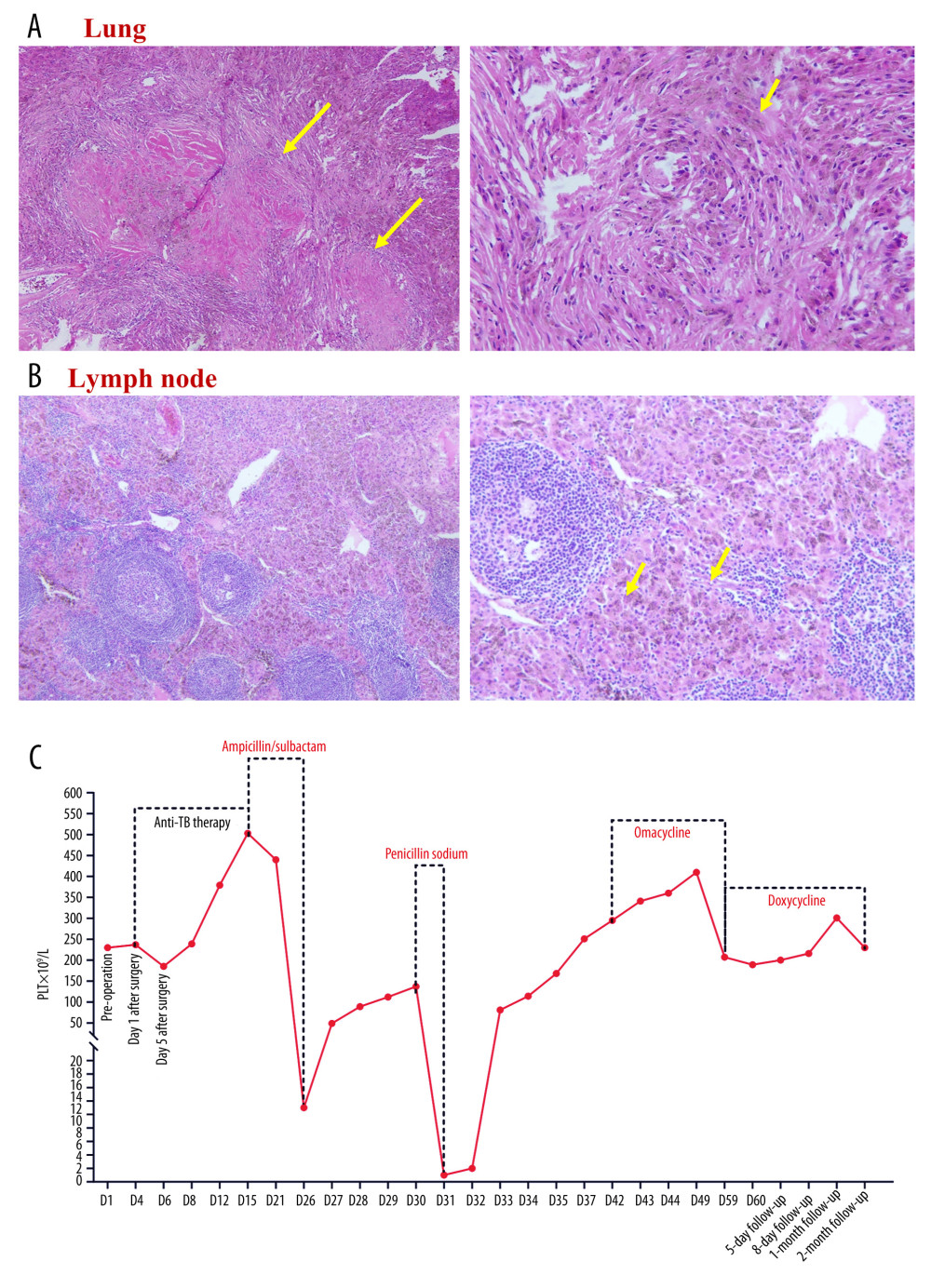 Histopathologic and hematologic findings(A, B) Histopathologic examination of the surgical lung and lymph node specimens showed necrotizing granulomatous inflammation with carbon deposition and numerous macrophages containing carbon particles. (C) Changes in platelet count during the treatment course. Abbreviations: PLT, platelets; TB, tuberculosis.
