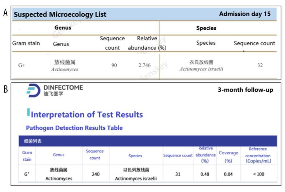 Serial BALF mNGS resultsImage shows BALF mNGS findings from admission day 15 (A), and 3-month follow-up (B). In panel A, Actinomyces israelii was identified as a suspected pathogenic microorganism, with 32 sequence reads. In panel B, Actinomyces israelii was identified as a pathogenic microorganism, with 31 sequence reads. Abbreviations: BALF, bronchoalveolar lavage fluid; mNGS, metagenomic next-generation sequencing.