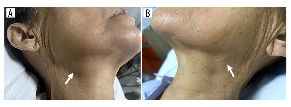 Clinical photographs obtained 18 hours after intravenous iodinated contrast administration demonstrate asymmetric swelling of the submandibular regions, more pronounced on the right (A) than on the left (B) (arrows).