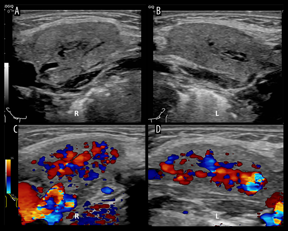 Ultrasonographic images of the submandibular glands obtained 18 hours after contrast administration. (A, B) Gray-scale images of the right (A) and left (B) submandibular glands demonstrate mild heterogeneous parenchymal echotexture with mild intraglandular ductal dilatation. (C, D) Color Doppler images demonstrate increased parenchymal vascularity within the right (C) and left (D) submandibular glands.