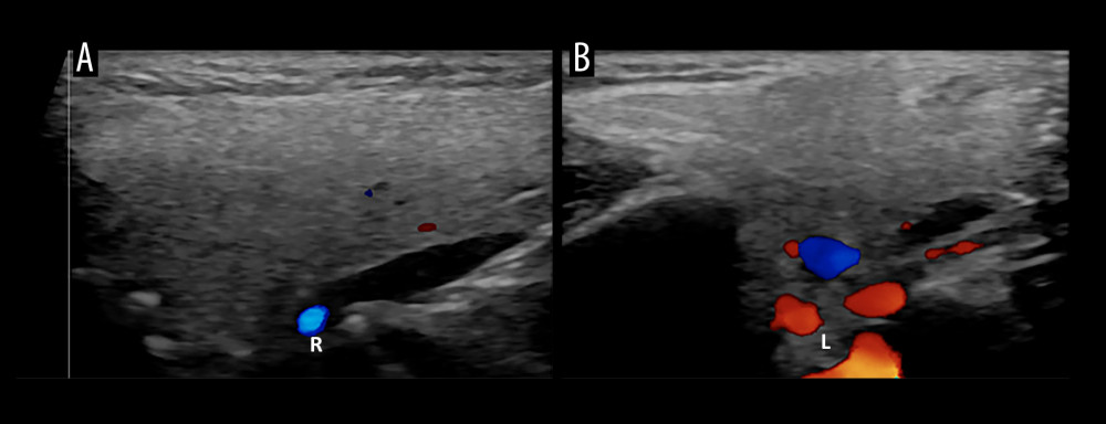 Color Doppler ultrasonographic images of the right (A) and left (B) parotid glands demonstrate homogeneous parenchymal echotexture without abnormal vascularity.