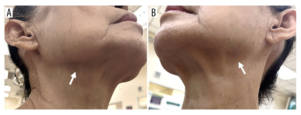 Follow-up clinical photographs obtained 7 days later demonstrate complete resolution of the previously noted swelling in the right (A) and left (B) submandibular regions (arrows).