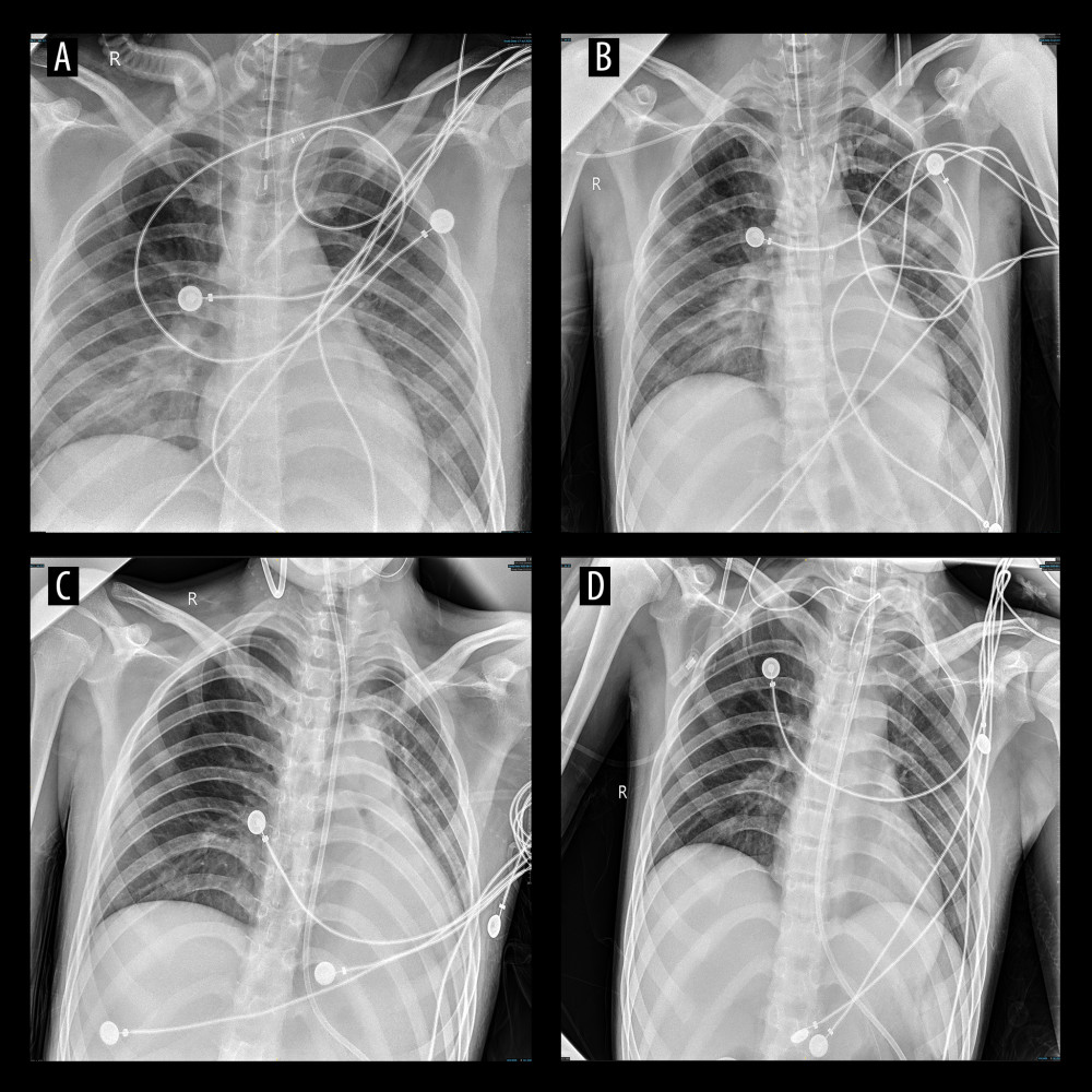 Chest X-ray findings of the patientChest radiographs obtained at different time points during hospitalization. On hospital day 3 (A), slightly increased and thickened pulmonary markings with patchy opacities and blurred margins were observed in both lower lung fields. On hospital day 7 (B), a patchy area of increased density with blurred margins was observed in the middle field of the left lung. On hospital day 24 (C), compared with previous findings, patchy opacities in the middle and lower lung fields were partially absorbed. A patchy area of increased density with relatively clear margins was observed in the upper field of the right lung, with local pleural adhesion at the right lung apex. On hospital day 34 (D), pulmonary markings were distinct, with no obvious abnormalities detected.