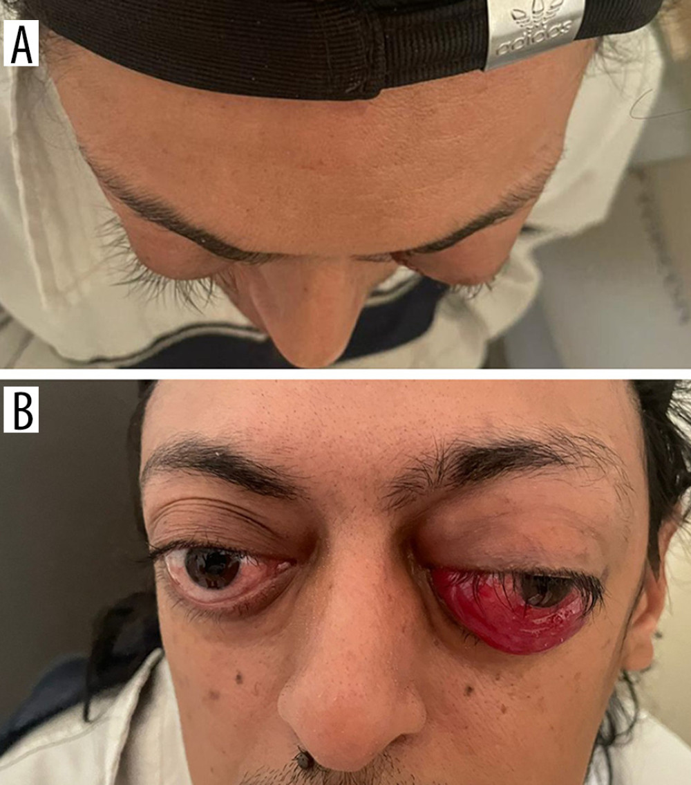 Initial clinical presentation of the patient. (A) Proptosis (OD: 26 mm; OS: 29 mm). (B) Inferior conjunctival chemosis of the left eye.