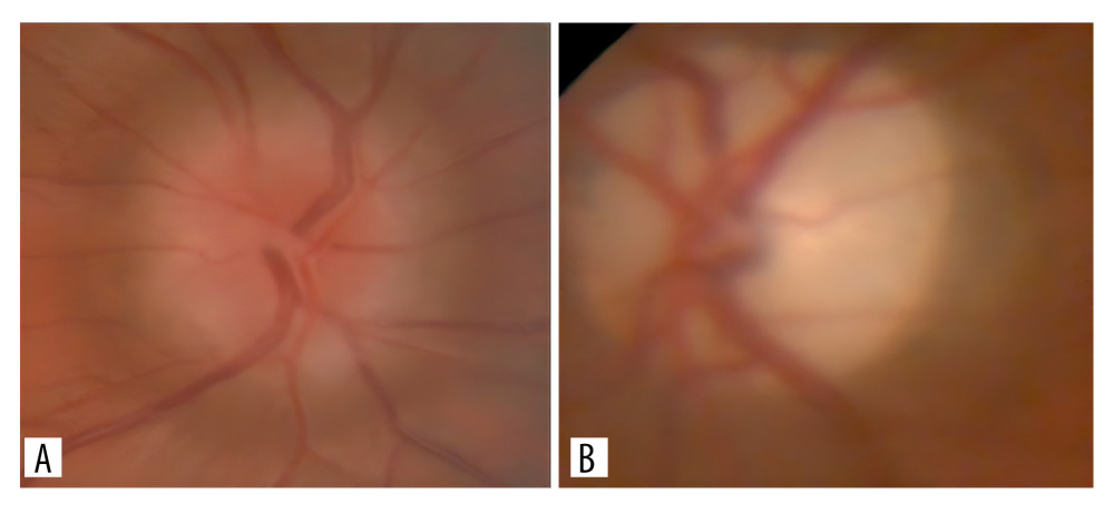 Initial fundus appearance of the patient. (A) Papilledema, Frisén grade II, in the right eye (OD). (B) Total optic disc pallor in the left eye (OS).