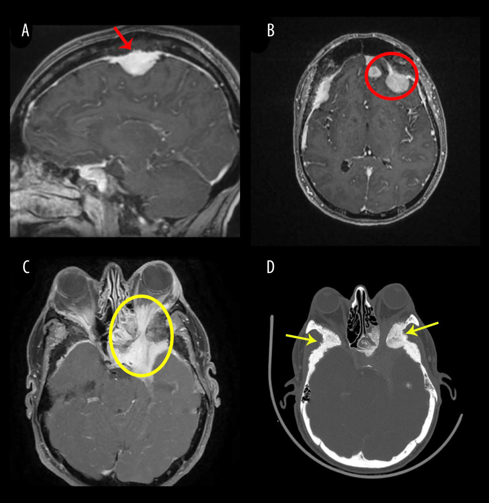 Imaging findings of the patient. (A) Sagittal T1-weighted post-gadolinium magnetic resonance imaging demonstrating a homogeneously enhancing parasagittal extra-axial meningioma with invasion of the superior sagittal sinus (red arrow). (B) Axial T1-weighted post-gadolinium MRI showing multiple left frontal convexity meningiomas adjacent to the falx (red circle). (C) Axial T1-weighted post-gadolinium magnetic resonance imaging demonstrating a meningiomatous lesion involving the left cavernous sinus with extension into the ipsilateral orbit through the optic canal(yellow circle). (D) Axial computed tomography bone window demonstrating marked hyperostotic and sclerotic changes of the sphenoid bone with a spiculated pattern (yellow arrows).