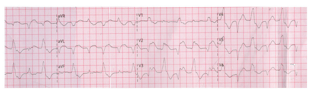 Electrocardiogram obtained at presentation demonstrating bidirectional ventricular tachycardia. The rhythm is characterized by a ventricular rate of approximately 125 to 130 bpm, widened QRS complexes (140–160 ms), and beat-to-beat alternation of the QRS axis, consistent with bidirectional ventricular tachycardia.