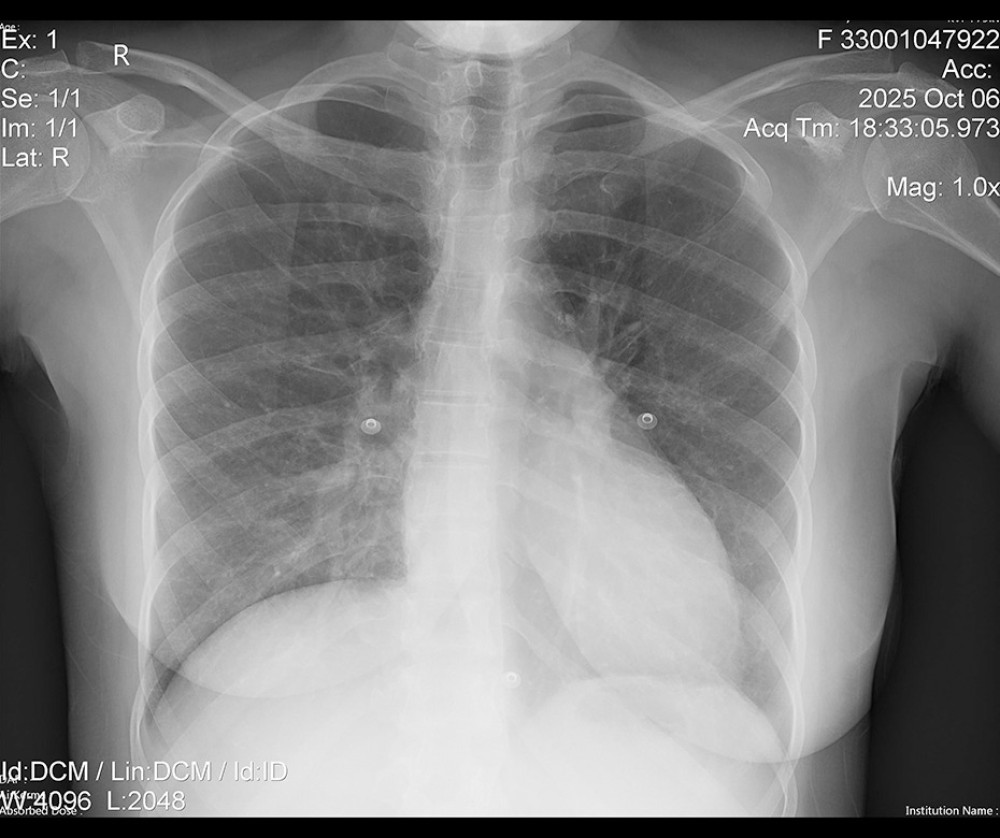 Anteroposterior chest radiograph. The image demonstrates well-aerated lungs without clinically significant loss of aeration. Structural findings include mild right basilar fibrotic changes, localized peribronchial thickening, and minimal pleural reaction. The hila appear prominent without focal abnormality, and the pulmonary vasculature is mildly prominent. The costophrenic angles and mediastinal contours are within normal limits.