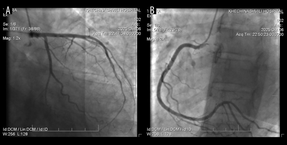 (A) Left coronary angiogram demonstrating a normal left main coronary artery bifurcating into the left anterior descending and left circumflex arteries, without evidence of atherosclerotic disease. (B) Right coronary angiogram showing a normally originating right coronary artery with smooth vessel walls and no evidence of atherosclerotic disease.