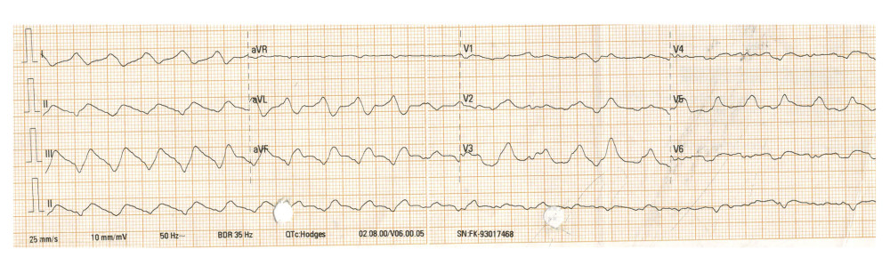 Electrocardiogram rhythm strip demonstrating polymorphic ventricular tachycardia. The single-lead rhythm strip documents the onset of polymorphic ventricular tachycardia with a ventricular rate of approximately 150 bpm, characterized by substantially widened (> 240 ms) and deformed QRS complexes approaching a sine-wave pattern, accompanied by severe repolarization abnormalities secondary to global myocardial electrical instability. This rhythm carries a high risk of degeneration into ventricular fibrillation, which subsequently developed.