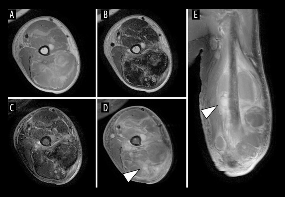 Magnetic resonance imaging (MRI) findings at the initial presentationMRI shows a multilocular lesion measuring 16.1 × 8.1 × 5.3 cm, mainly within the left triceps brachii muscle, extending to the flexor and extensor aspects of the upper arm. The lesion has iso- to high-signal intensity on T1-weighted images (A, axial) and peripheral high-signal intensity with internal low-signal intensity on T2-weighted images (B, axial). On short tau inversion recovery (STIR) images, the internal low-signal components are more clearly delineated (C, axial). Gadolinium-enhanced MRI shows heterogeneous enhancement in part of the lesion (arrowheads) (D, axial; E, coronal).