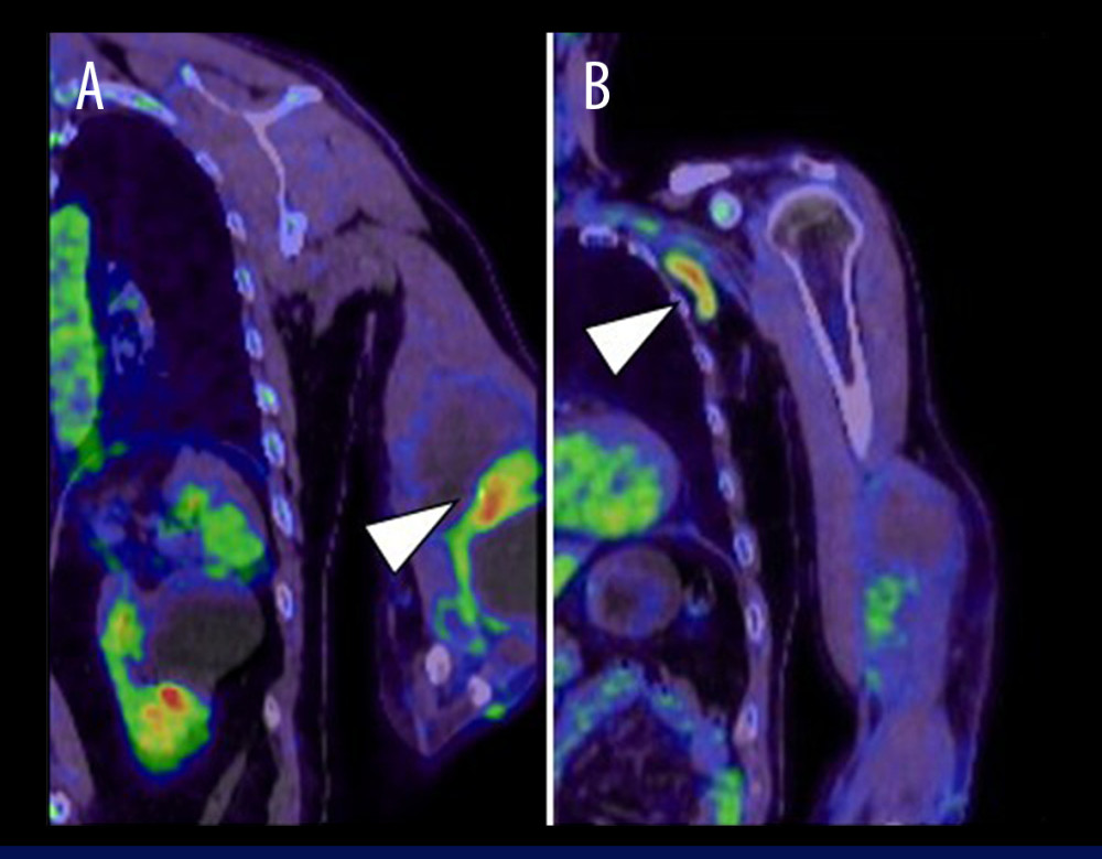 Fluorodeoxyglucose positron emission tomography/computed tomography (FDG-PET/CT) findings at the initial presentationFDG-PET/CT shows FDG uptake with a maximum standardized uptake value (SUVmax) of 5.3 in the septal components of the lesion (arrowhead) (A, coronal). In addition, there is FDG uptake in the left axillary lymph node (arrowhead) (B, coronal).