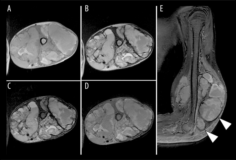 Magnetic resonance imaging (MRI) findings at the re-presentationMRI shows a multilocular cystic lesion measuring approximately 15.0 × 17.6 × 10.0 cm in the distal portion of the left upper arm. The lesion has iso-to-high-signal intensity on T1-weighted images (A, axial), and slightly low-signal intensity on T2-weighted images (B, axial) and short tau inversion recovery images (C, axial). Gadolinium-enhanced MRI shows solid components with contrast enhancement adjacent to the cystic lesion (arrowheads) (D, axial; E, sagittal).