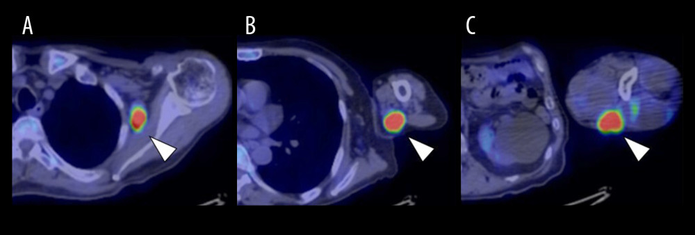 Fluorodeoxyglucose (FDG) positron emission tomography/computed tomography (PET/CT) findings at the re-presentationThere is FDG uptake with a maximum standardized uptake value (SUVmax) of 10.5 in the left axillary lymph node (arrowhead) (A, axial). In addition, there is FDG uptake with an SUVmax of 15.0 in a proximal dorsal nodule of the left upper arm (arrowhead) (B, axial), and FDG uptake with an SUVmax of 15.2 in a distal dorsal nodule (arrowhead) (C, axial).