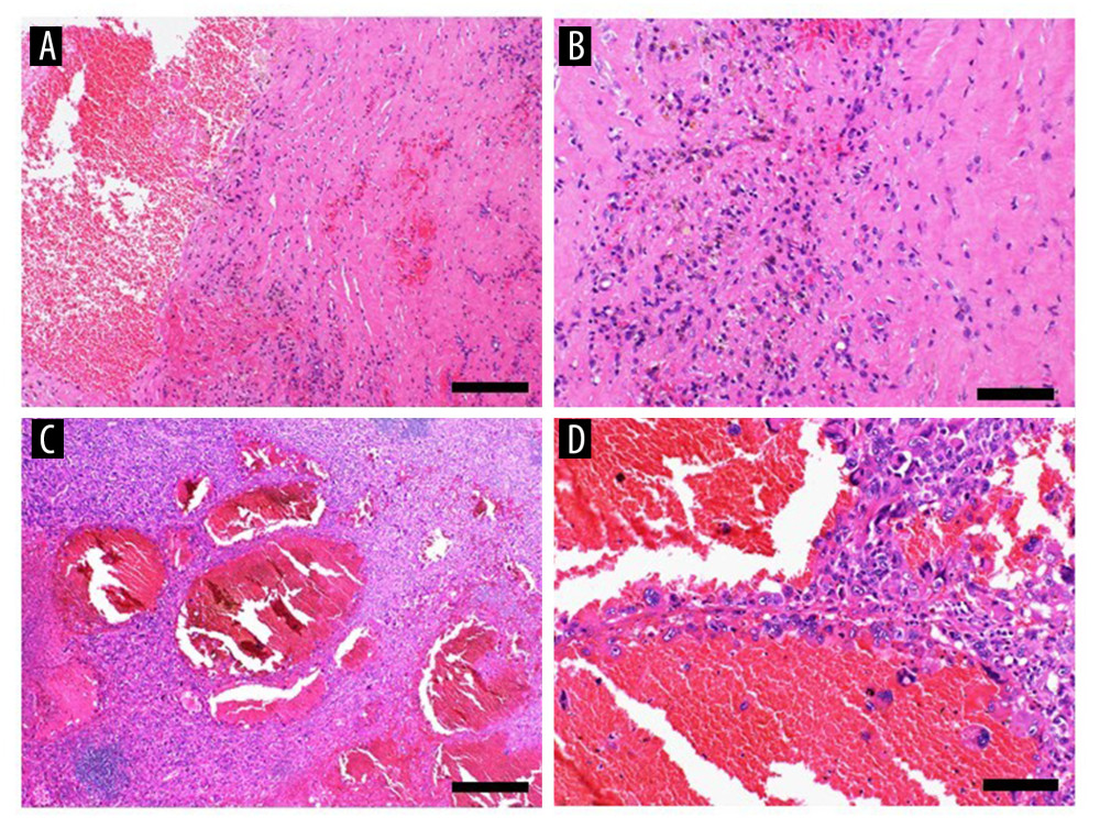 Histopathological findingsThe biopsy specimen had a structure consistent with a cyst wall composed of thick fibrous connective tissue, with no definitive atypical tumor cells (A, hematoxylin and eosin [H&E] stain, × 100) (bar, 200 μm). There are numerous hemosiderin-laden macrophages on the surface of, and within, the fibrous connective tissue, which are presumed to represent the cyst wall (B, H&E stain, × 200) (bar, 100 μm). Surgical specimens reveal multiple multilocular cysts containing hemorrhagic components. In addition, areas with hemangioma-like architecture and regions have solid proliferation of tumor cells (C, H&E staining, × 40) (bar, 500 μm). There are markedly atypical tumor cells lining the vascular-like spaces are at the periphery of the hemangioma-like structures (D, H&E stain, × 200) (bar, 100 μm).