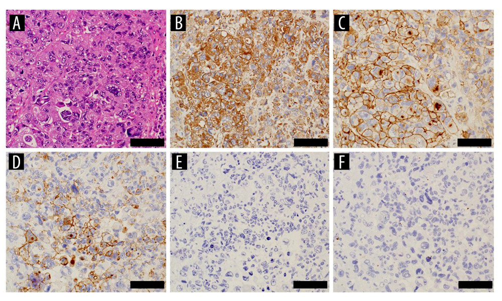 High-power views of H&E staining and immunohistochemical stainings of the surgical specimenSolid proliferation of the tumor cells is observed (A, × 200) (bar, 100 μm). The tumor cells show diffuse positivity for vimentin (B, × 200) and CD99 (C, × 200), and focal positivity for EMA (D, × 200), but negativity for AE1/AE3 (E, × 200) and desmin (F, × 200) (bars, 100 μm).