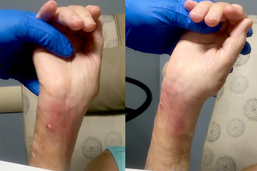 External appearance of affected forearm and wrist. Notable are the open draining wound site on the volar forearm and associated erythema radiating out into the rest of the forearm proximally and the wrist distally.