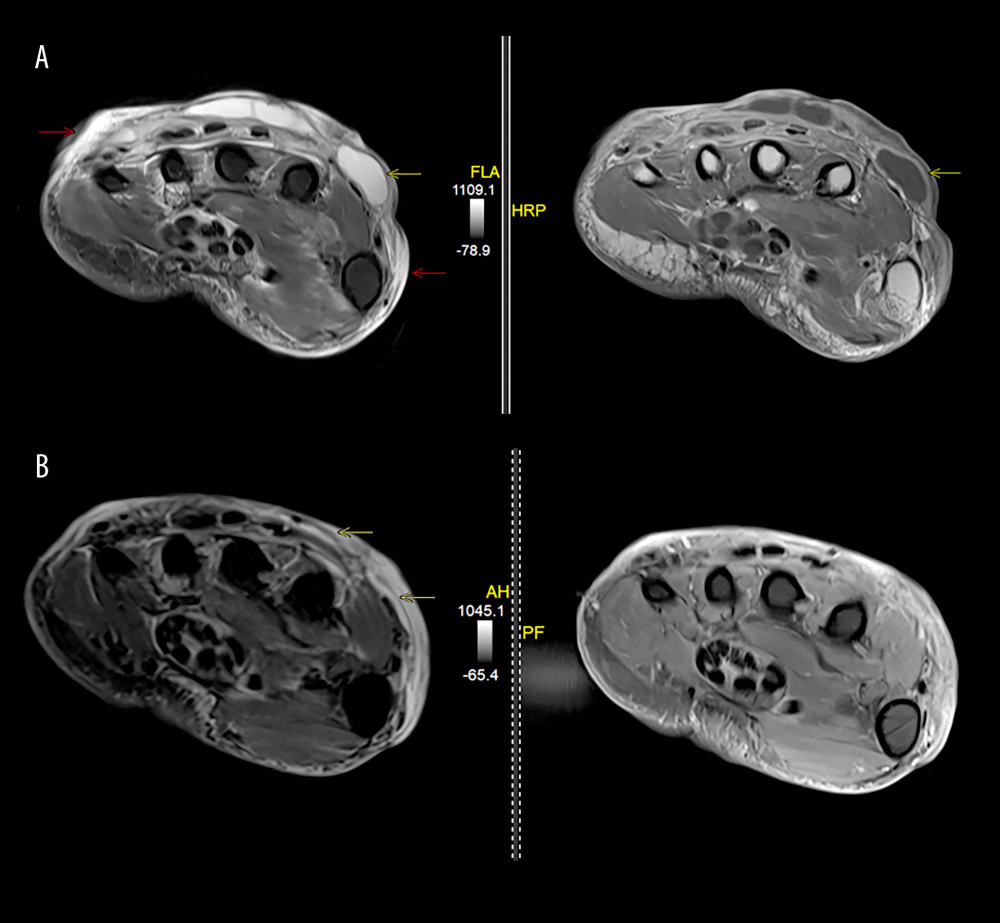(A) Axial fat-suppressed T2-w and axial T1-w contrast-enhanced magnetic resonance images of the right hand at the level of the proximal metacarpals demonstrate extensive ill-defined subcutaneous edema (red arrows) and several rim-enhancing fluid collections (yellow arrows) involving the dorsal hand, suggesting cellulitis with abscesses. (B) Axial fat-suppressed T2-w and axial T1-w contrast-enhanced magnetic resonance images at the same level as in (A), which were obtained 8 weeks later, demonstrate near complete resolution of fluid collections (yellow arrows) with persistent but decreased subcutaneous edema of the dorsal hand.