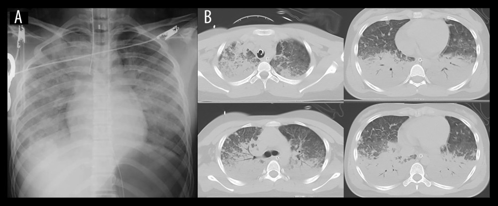 Chest imaging on admission(A) Chest X-ray demonstrated bilateral diffuse pulmonary infiltrates. (B) Chest computed tomography revealed diffuse bilateral ground-glass opacities and consolidation.