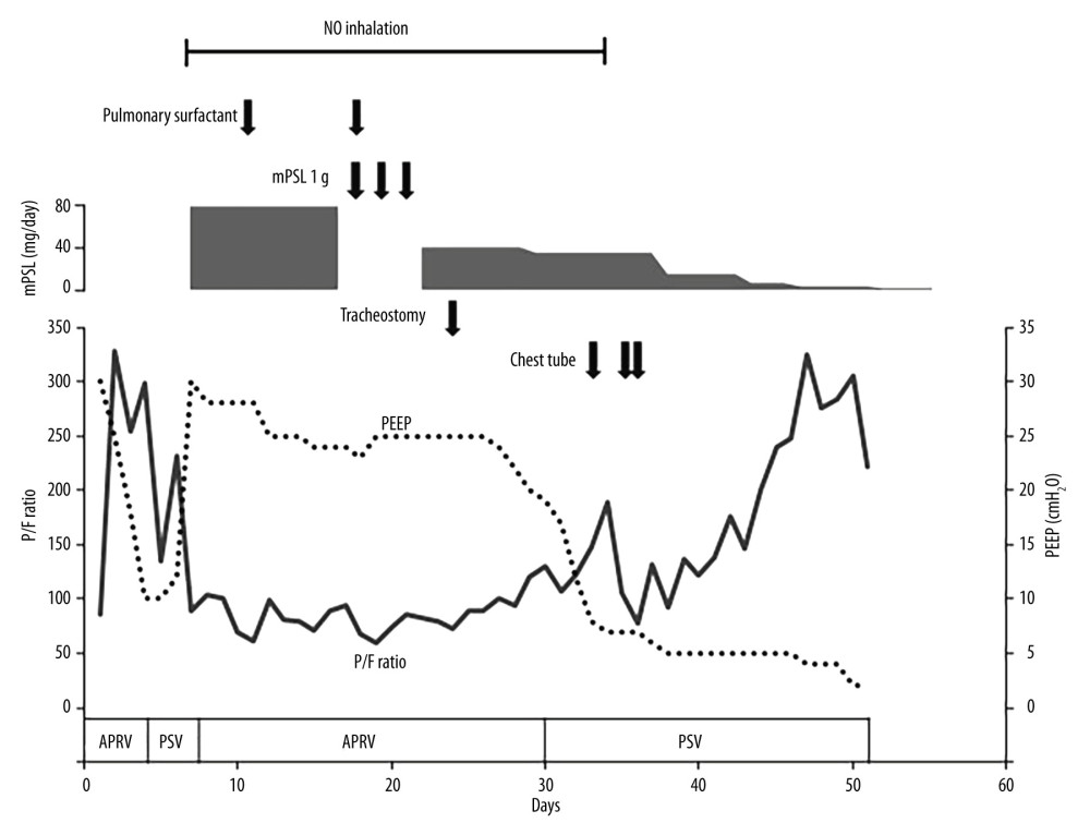 Clinical course of respiratory managementThe timeline shows major interventions, ventilator modes, corticosteroid therapy, and respiratory parameters during hospitalization. The solid line represents the PaO2/FiO2 (P/F) ratio, and the dotted line indicates positive end-expiratory pressure (PEEP). Ventilator modes used during the course are shown at the bottom (airway pressure release ventilation [APRV] and pressure support ventilation [PSV]). Gray bars indicate the dose of methylprednisolone (mPSL). Arrows denote the timing of tracheostomy and chest tube insertion, and the horizontal bar represents the period of inhaled nitric oxide (NO) therapy. Severe hypoxemia initially required high PEEP and APRV support; oxygenation gradually improved over time, allowing reduction of ventilatory support.