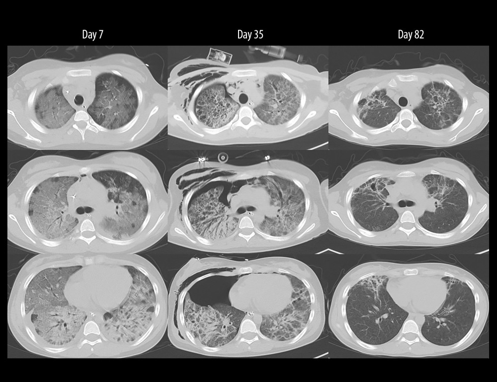 Serial chest computed tomography during the clinical courseChest computed tomography scans performed on days 7, 35, and 82 after admission show the temporal evolution of lung injury. On day 7, diffuse bilateral ground-glass opacities and consolidation compatible with acute respiratory distress syndrome were observed. On day 35, persistent bilateral infiltrates with fibroproliferative changes were evident, and a right-sided pneumothorax requiring chest tube placement had developed. By day 82, the lung opacities had markedly improved, with substantial resolution of the previously observed abnormalities.