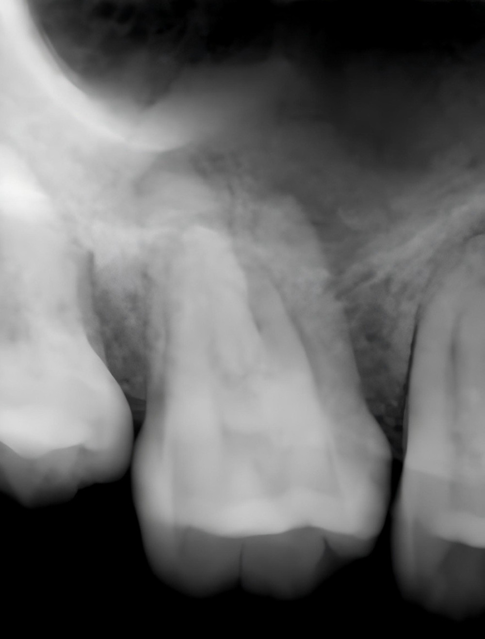 The initial periapical radiograph of the first molar of the right maxilla.